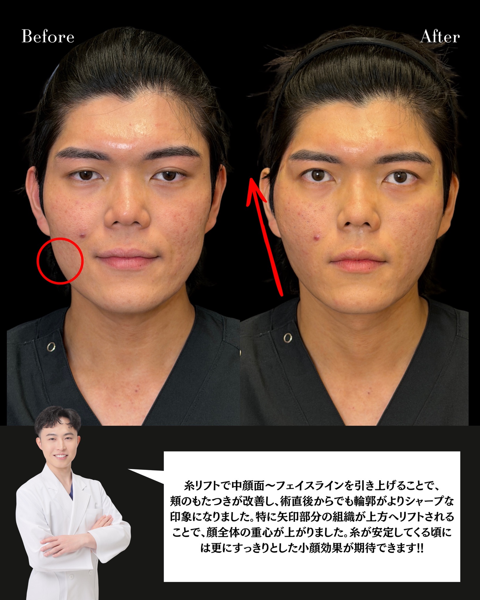 糸リフト(ストロング6本+テスリフト2本)の症例 解説