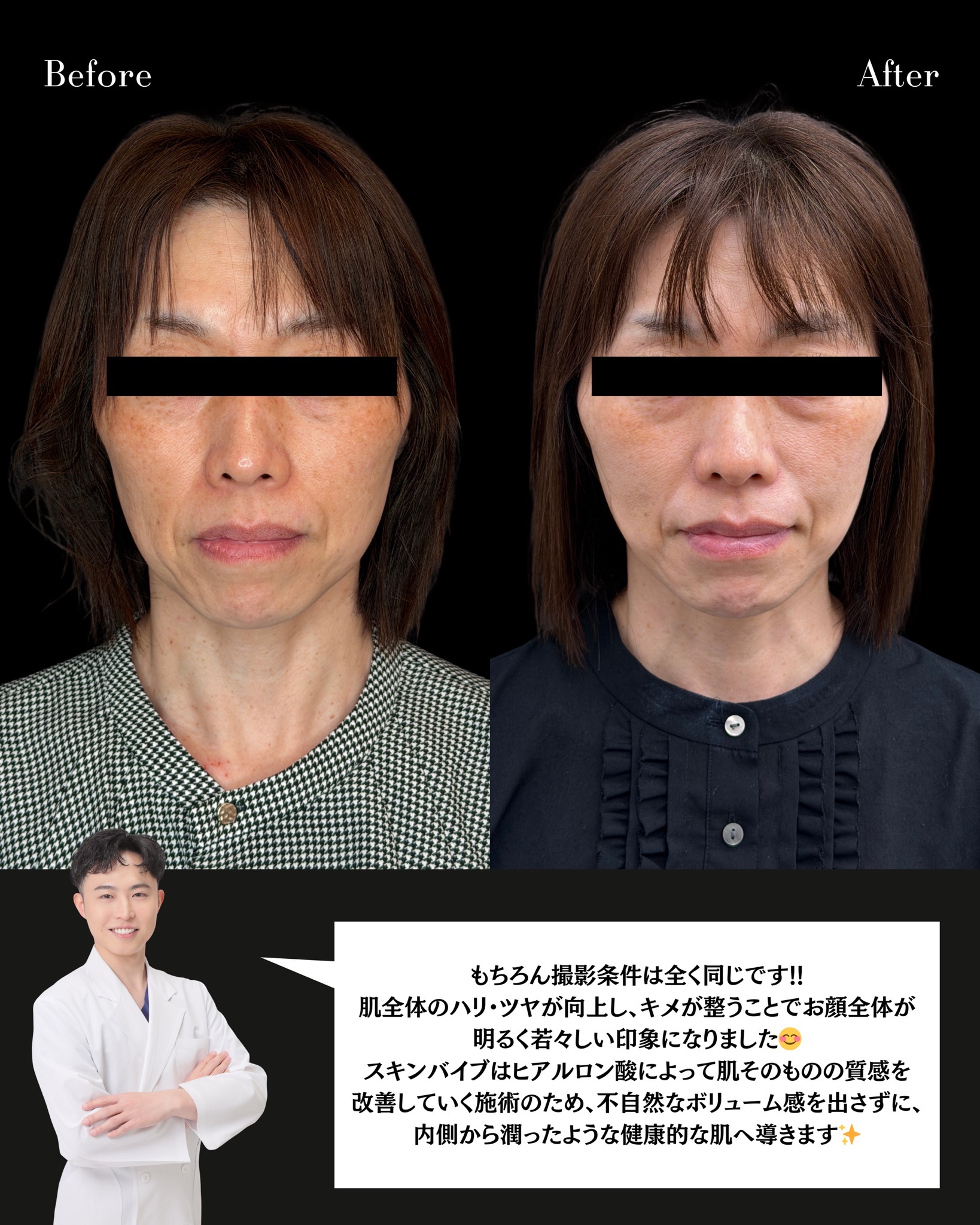 スキンバイブ(肌質改善ヒアルロン酸)の症例 解説