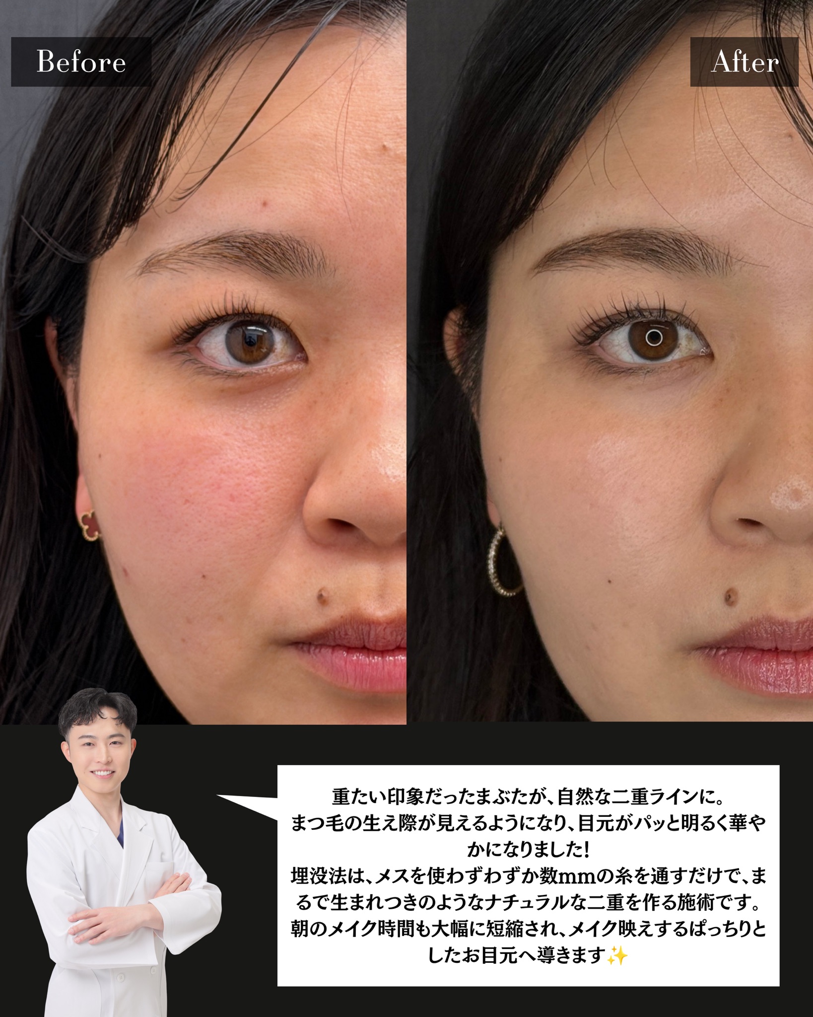 二重埋没法(自然癒着法)の症例 解説