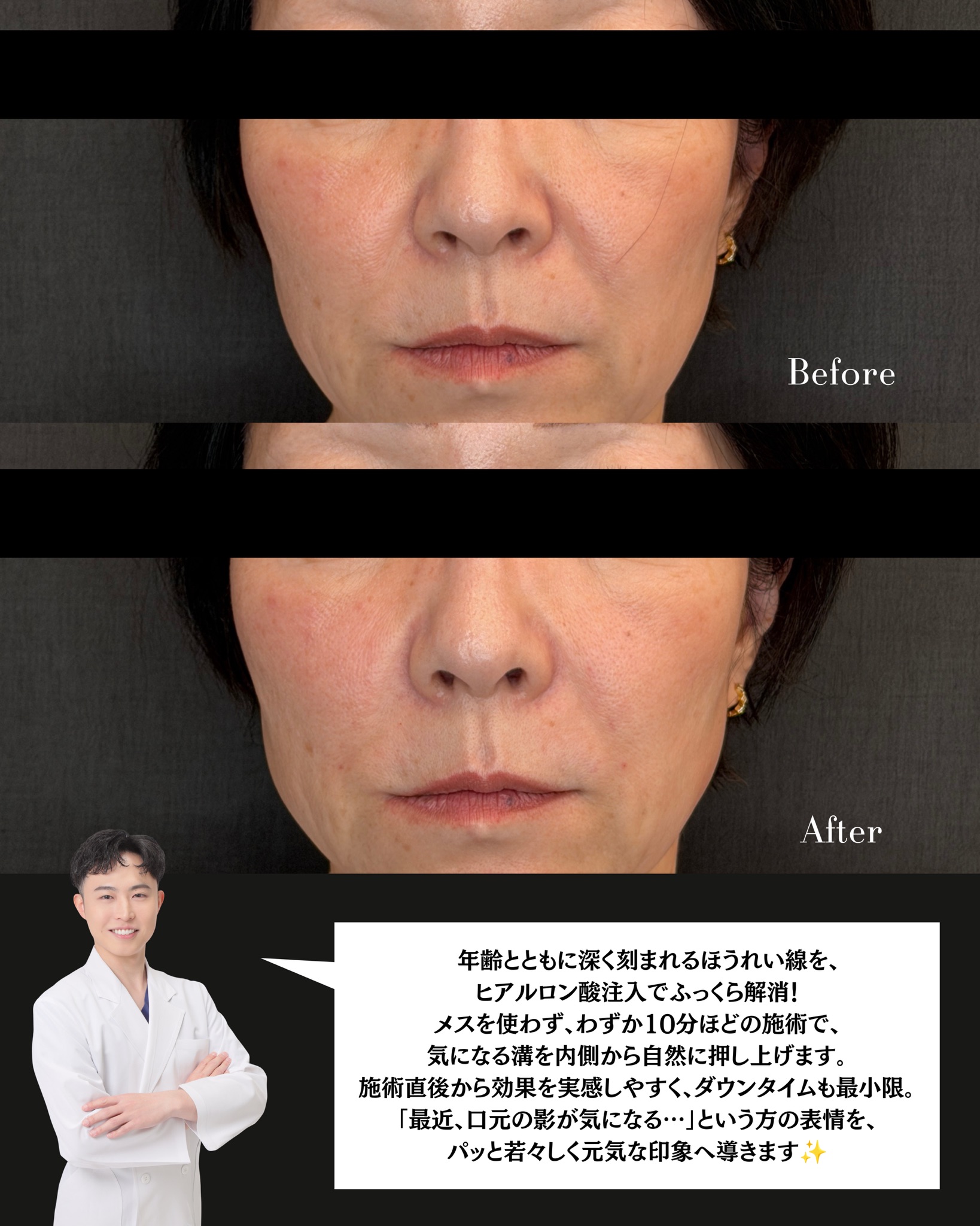 ヒアルロン酸(ほうれい線)の症例 解説