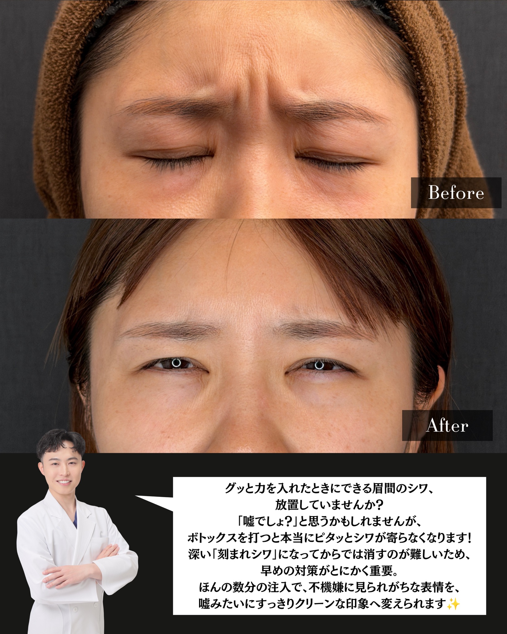 眉間ボトックス(アラガン製)の症例 解説