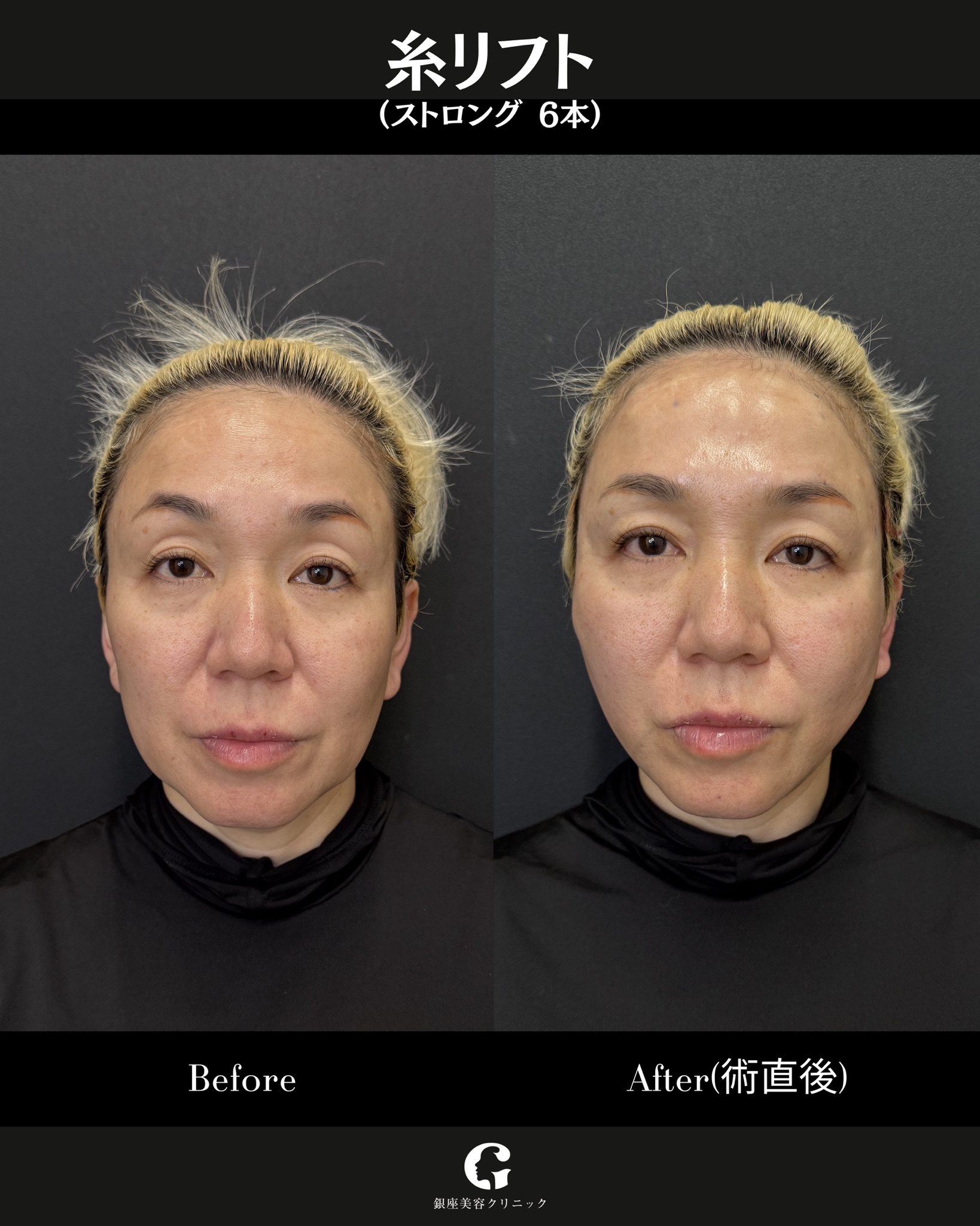 糸リフト(ストロング6本)の症例 ビフォーアフター