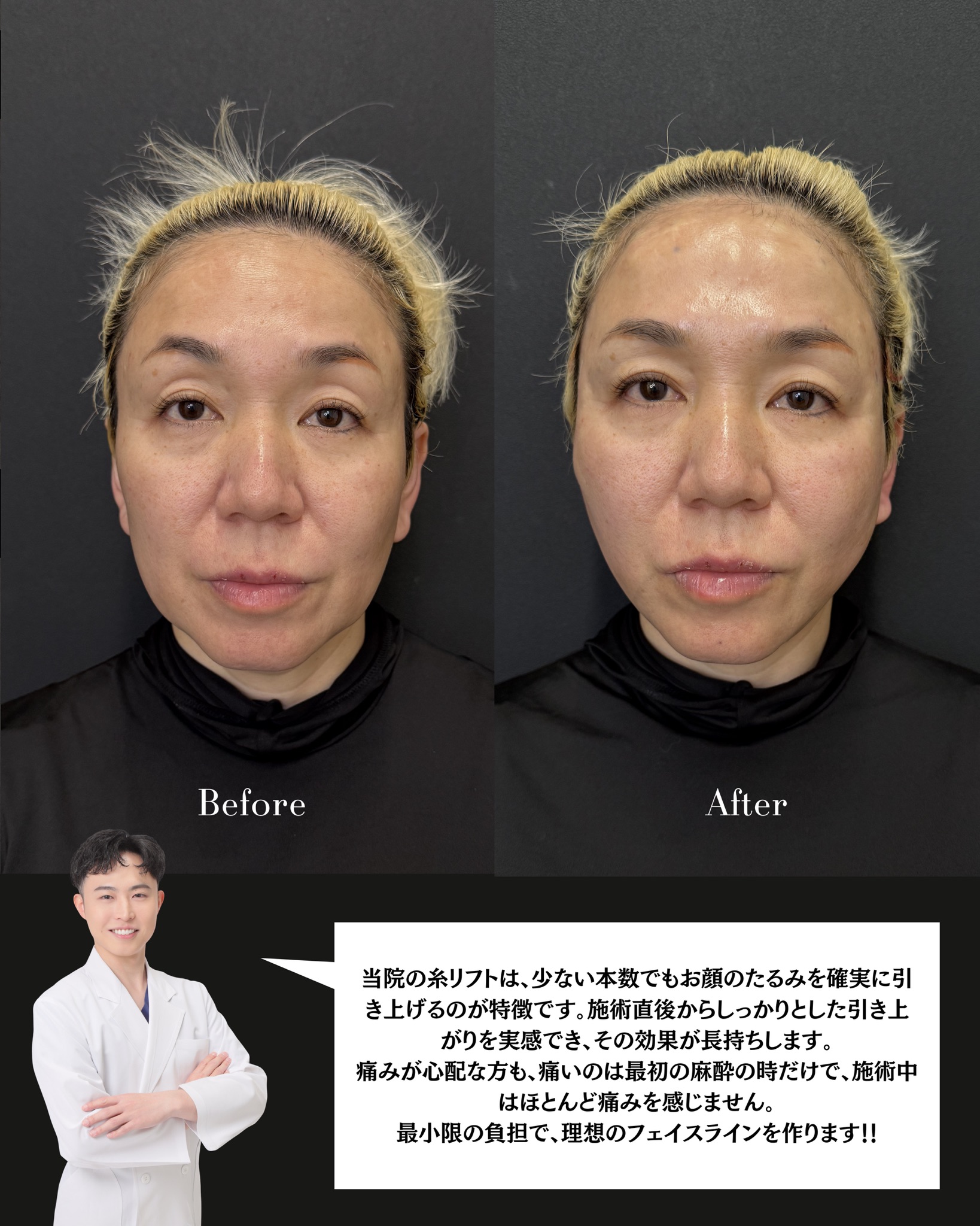 糸リフト(ストロング6本)の症例 解説