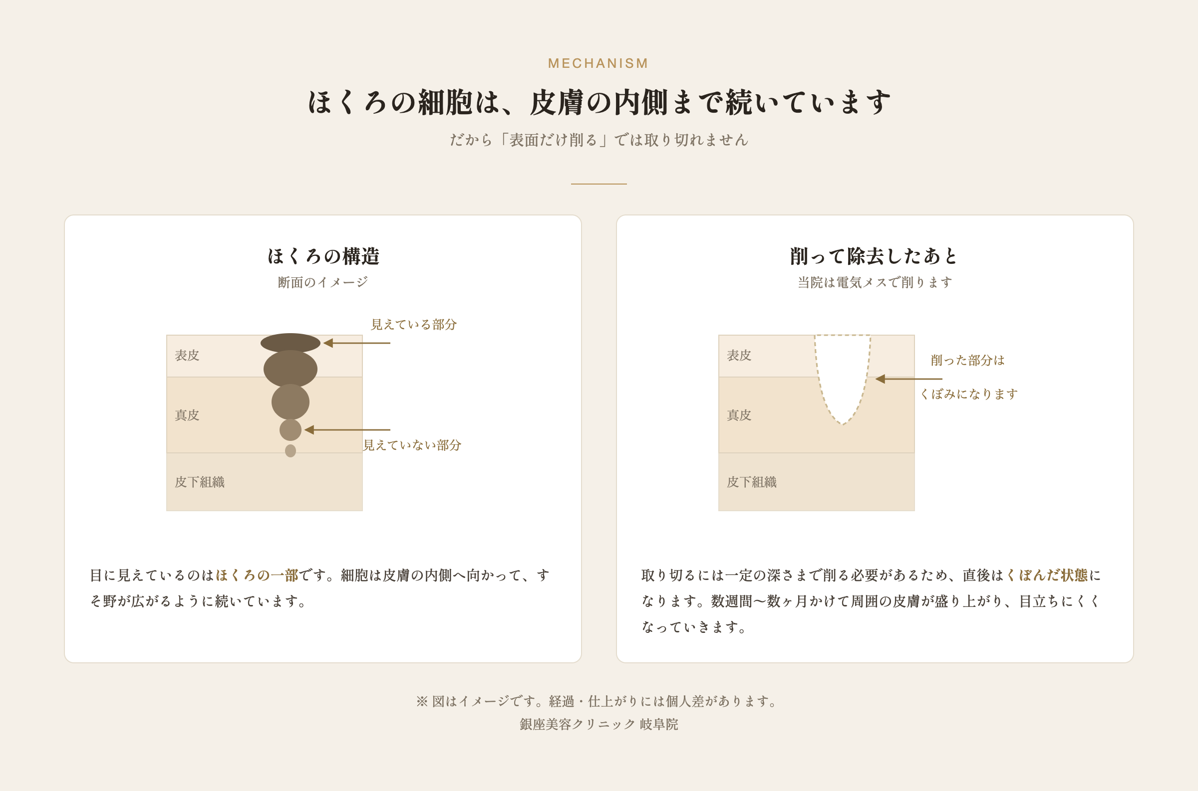 ほくろの細胞が皮膚の内側まで続いていることと、電気メスで削った後の断面の図解