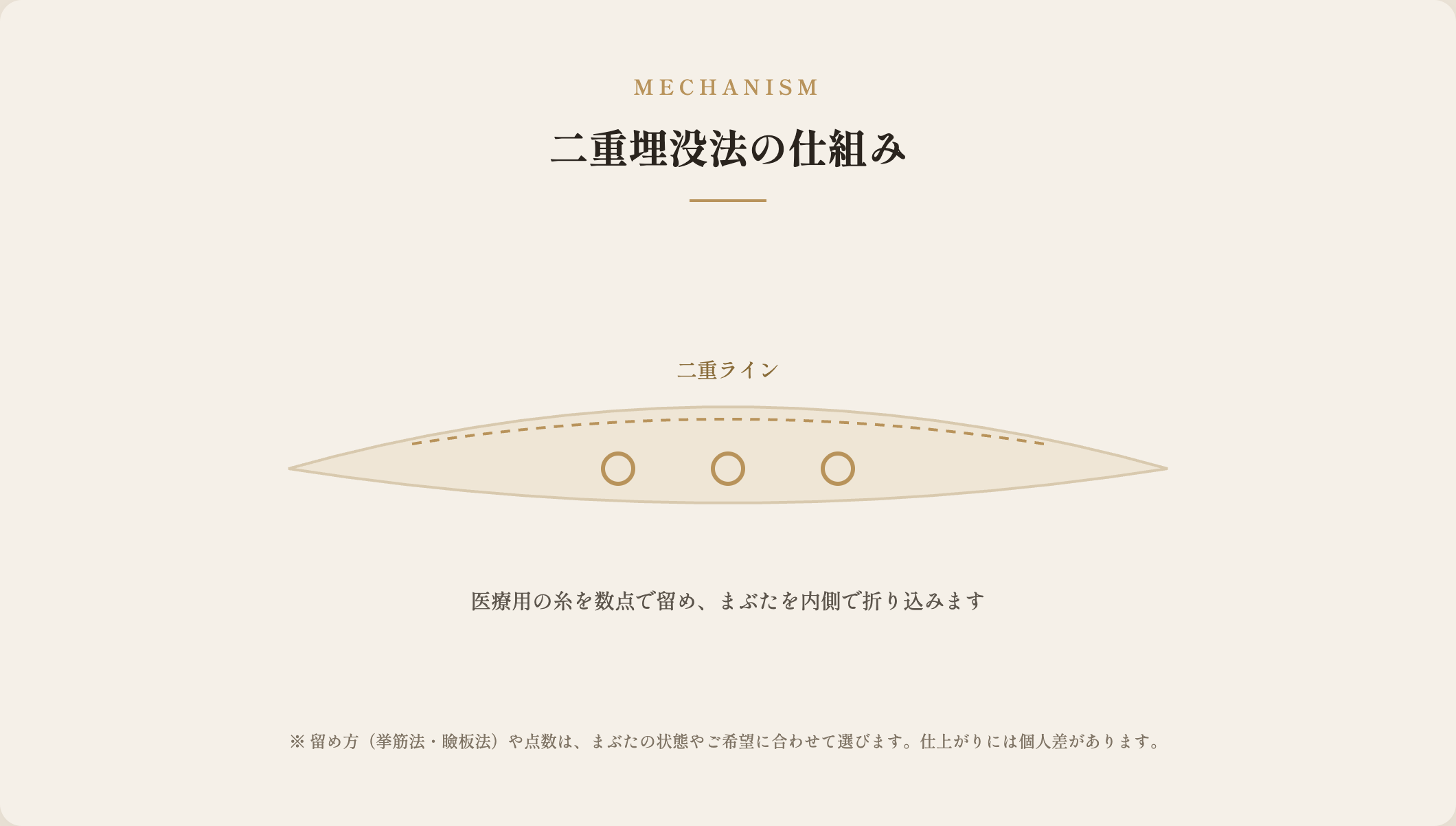 二重埋没法の仕組み(医療用の糸で数点留める)の図解